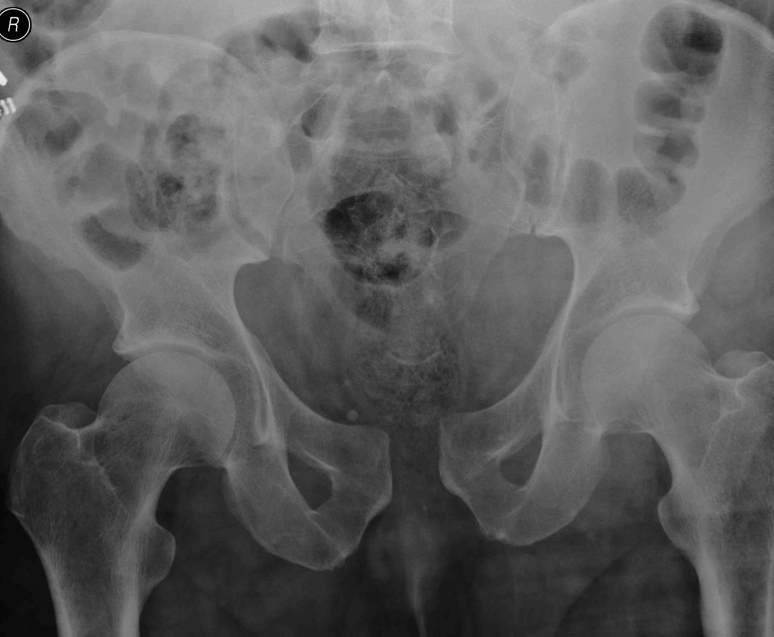 Pelvic Fracture APC 2